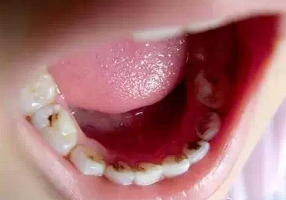 牙齿莫名变黑是为什么？牙上的小黑点该怎么去除？看看牙医怎么说
