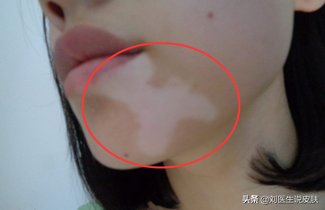 20岁女子患白癜风后，牢记医生说的这3个原则，然后白斑就没了