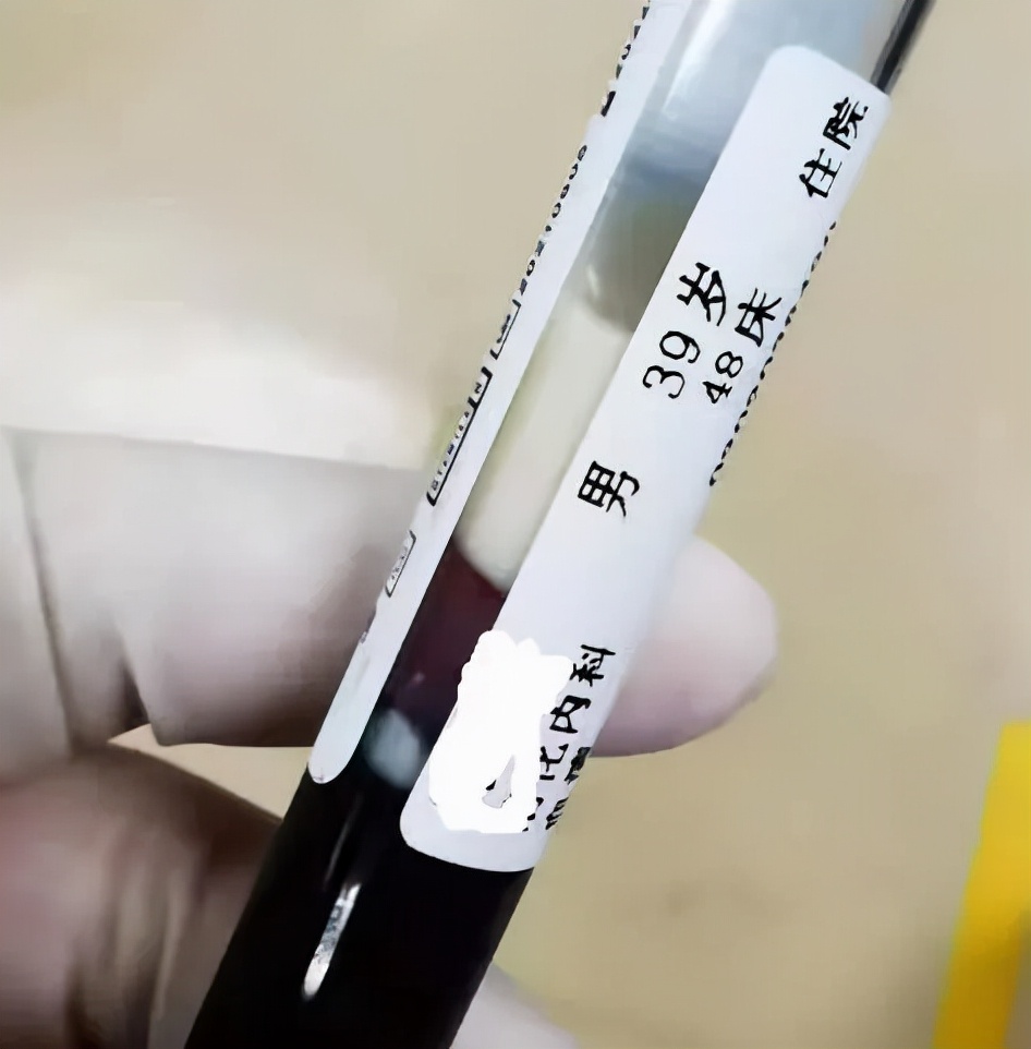 胰腺炎检查方法及饮酒警示