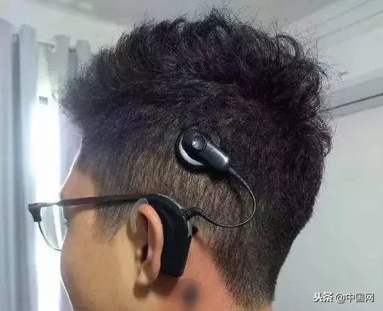“天价”人工耳蜗丢失引全城寻找……是炒作?