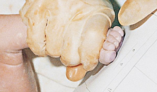 婴儿胎麻图片(图解产妇顺产全过程) - 乐宝宝贝