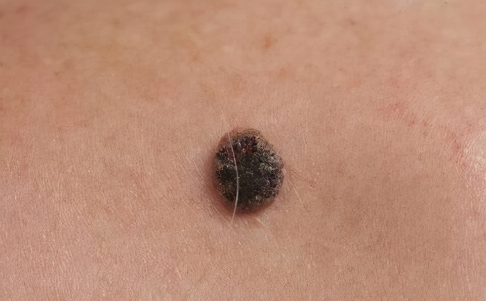 男性菜花状疣高清图片(皮肤上突然长出的小肉球) - 赤虎壹号