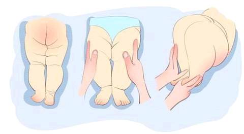 婴儿髋关节外展受限(女宝宝诊断为髋关节发育不良) - 乐宝宝贝