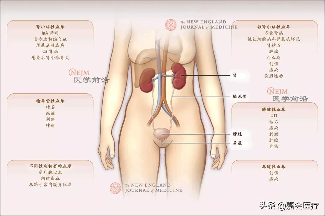 突发性血尿的原因及应对措施