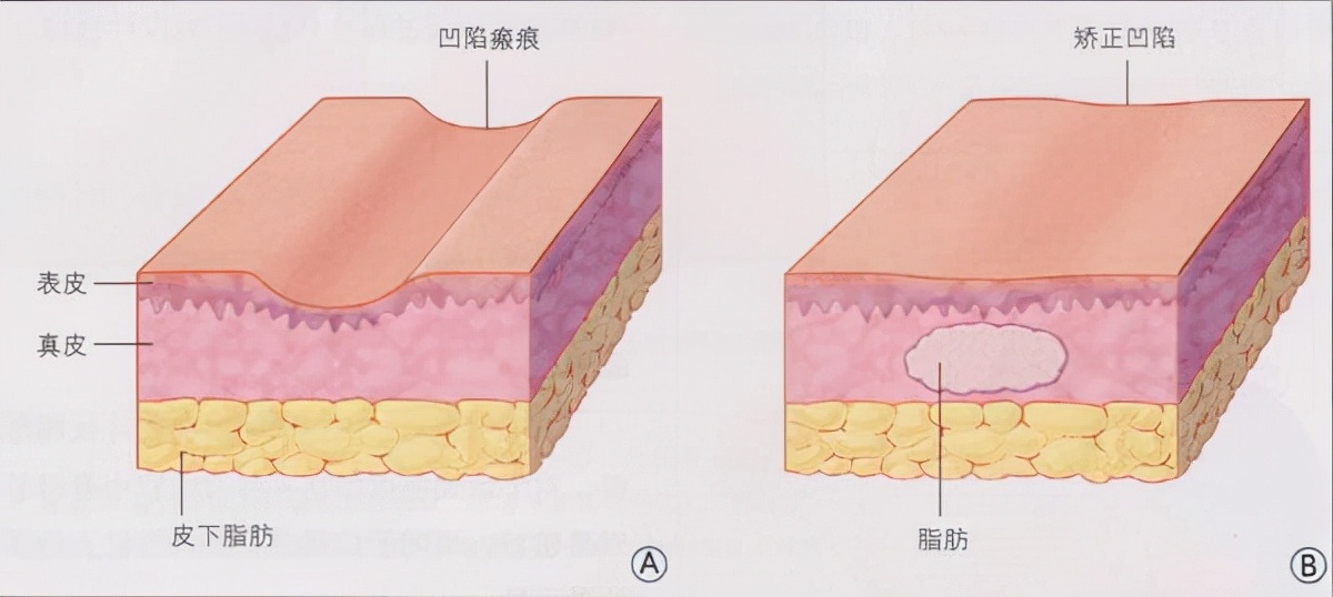 硬性下疳是什么 长什么样子