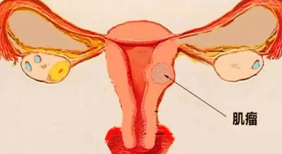子宫肌瘤的症状，宫肌瘤的治疗方法？