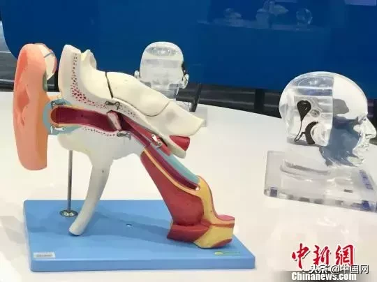 “天价”人工耳蜗丢失引全城寻找……是炒作?