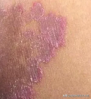 皮肤科常见疾病系列:尴尬部位的真菌感染「股癣」