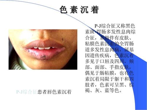 胰腺癌是癌中之王，胰腺癌的病因大揭秘，告诉你预防办法