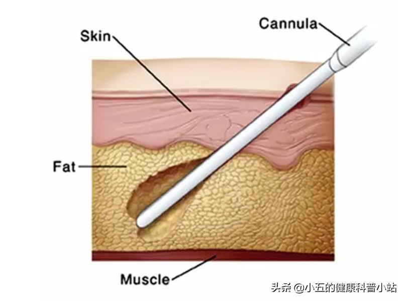 什么是脂肪瘤，它会癌变吗，我们应该怎么正确治疗脂肪瘤