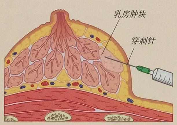 乳腺疾病常用的检查方法和治疗手段有哪些？看这篇文章你就明白了