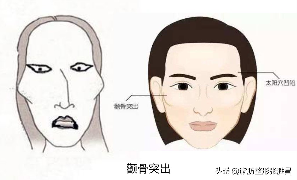 颧骨突出:一个影响你后天颜值的先天因素