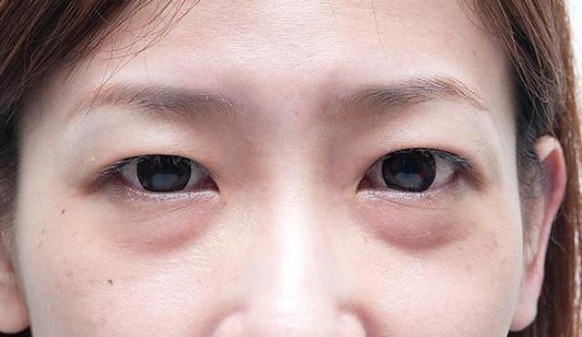 国外一女子花钱割了眼袋,如今"闭眼困难",其实变美不用这么麻烦