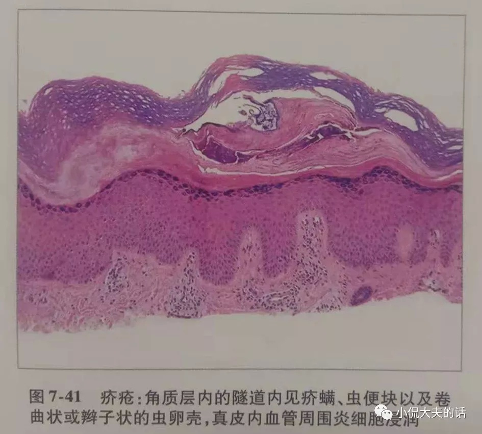 疥疮刚长是什么样子图片