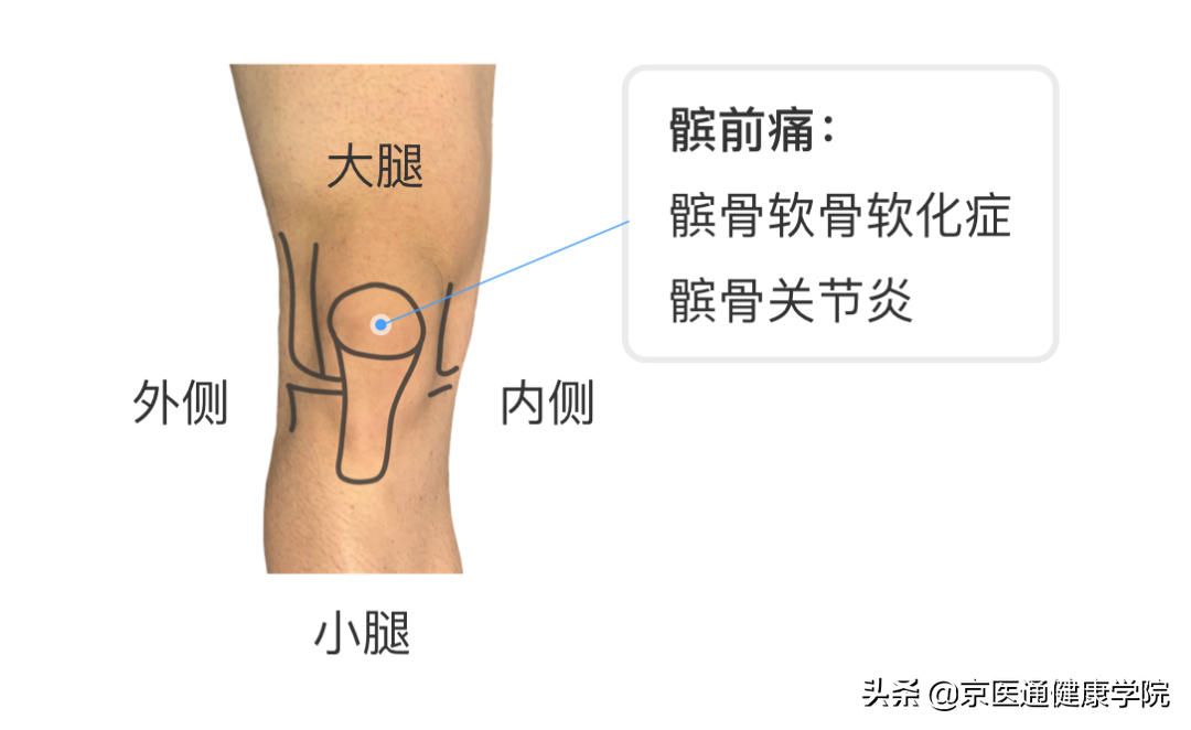 膝盖疼是什么病？积水潭专家教你1个动作判断