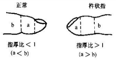 作为疾病较典型体征，杵状指的出现，预警着肺部健康出现问题