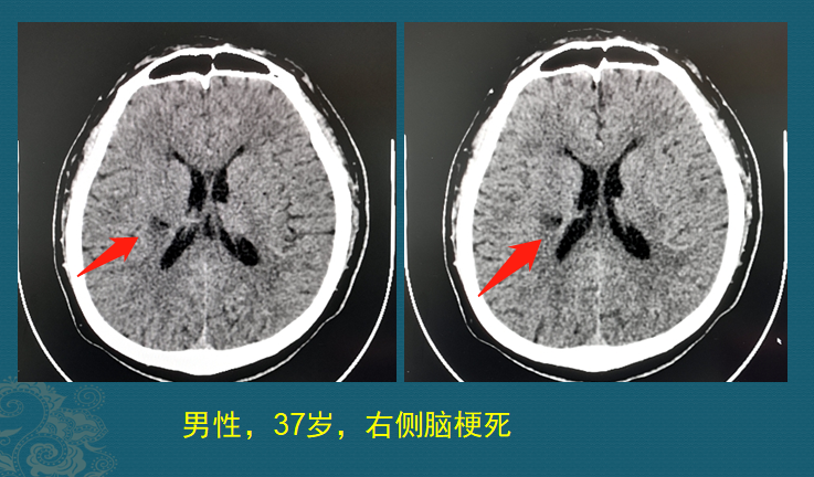 一瓶降压药值多少钱？3千到7万，这不是玩笑