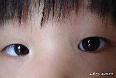 婴儿鼻尖一条竖线图片(孩子鼻梁上的) 