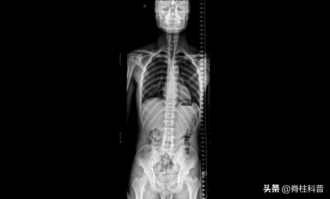 X光看不清，CT辐射大，腰突只想做最贵的核磁共振，为什么不行？