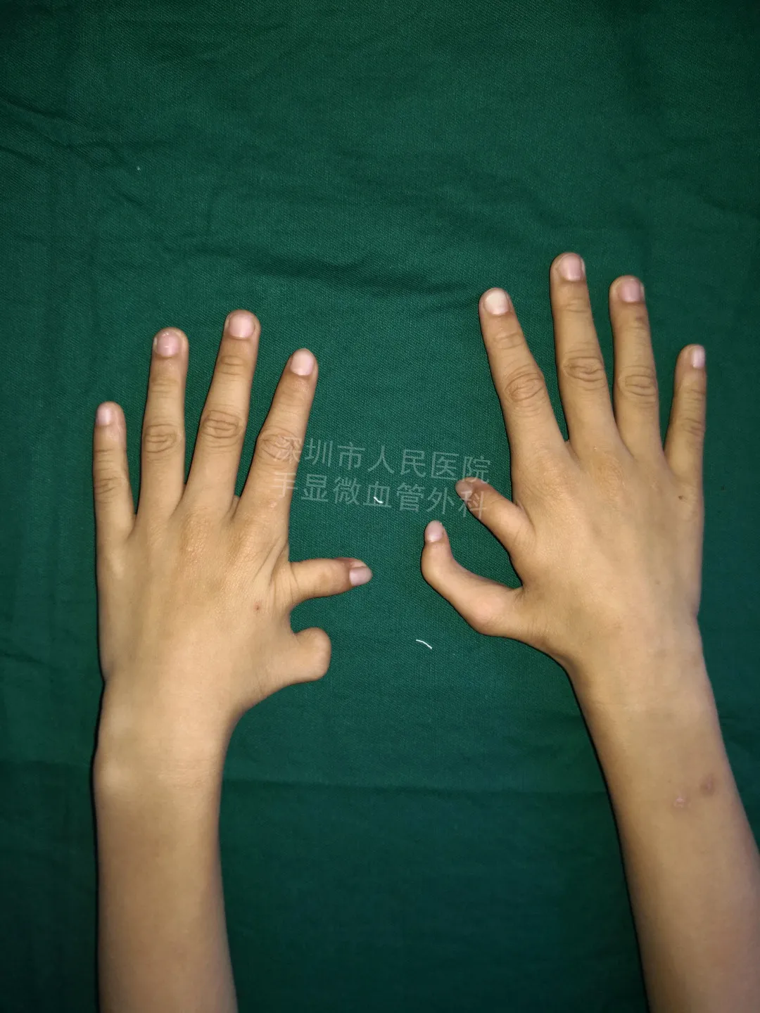 得了这病，12岁男孩手指比香蕉还粗！7种常见的手部畸形，家长们要注意