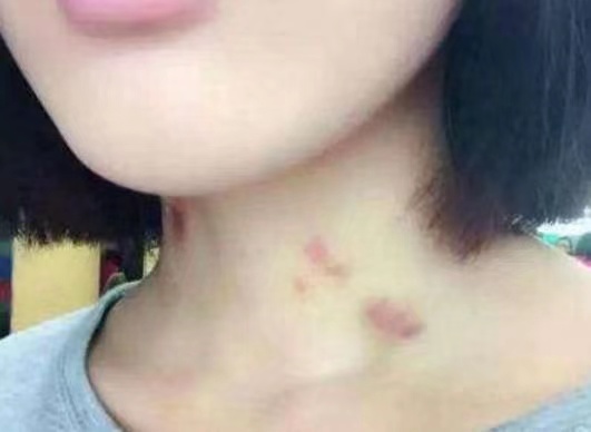 14岁女儿脖子现草莓印，一晚消除方法