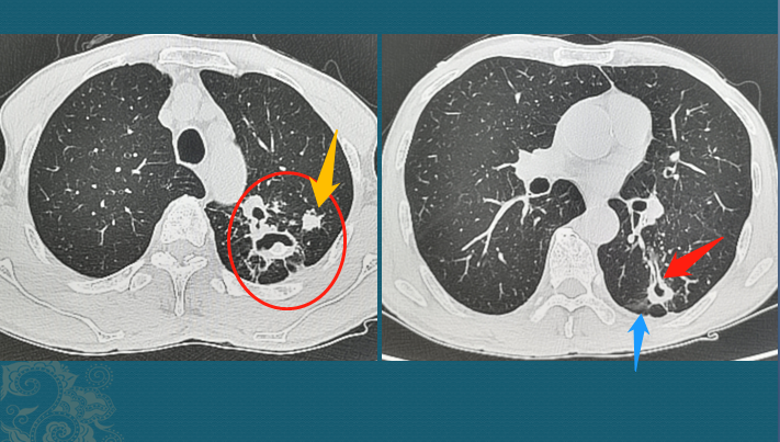 肺结核与肺癌,ct片怎么区分?医生教你4个读片小窍门