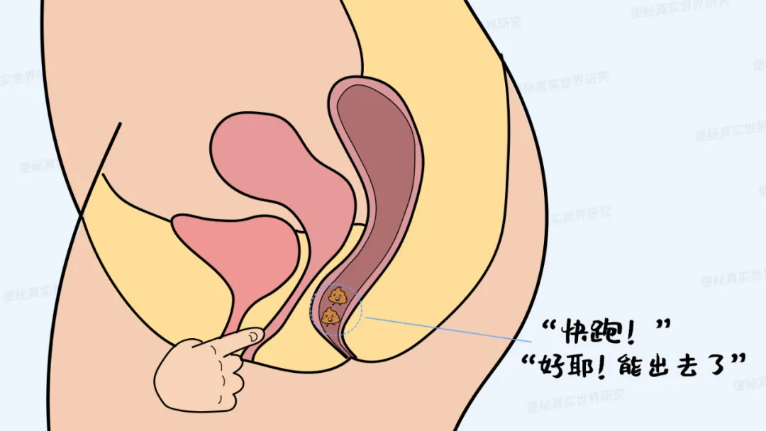 大便堵在肛门处，医生却让我多做这个动作