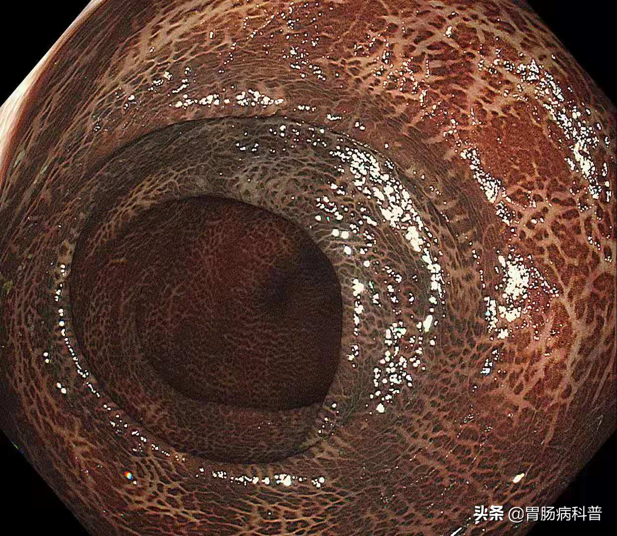 结肠黑变病(mc)是结肠黏膜固有层中巨噬细胞内色素聚集的一种黏膜色素