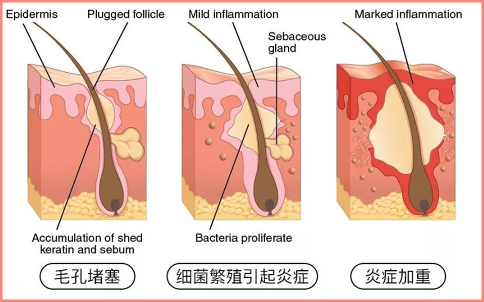 闭口痘痘肌看过来！刷酸超全攻略，助你变回鸡蛋肌