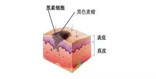 黑痣长在身上2个部位，特容易癌变！