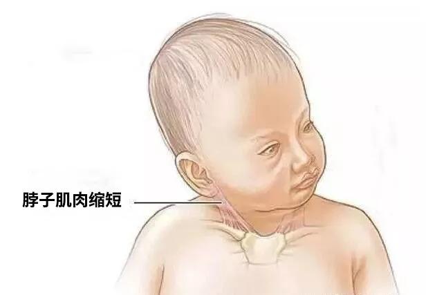 中国十大专治斜颈的整脊医院推荐名单