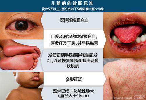 专家：孩子“红眼睛”，有5个症状要重视，其中1种可致心脏病