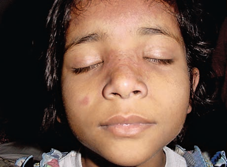 皮肌炎有什么样的皮肤改变?(1)