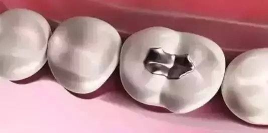 你补过牙吗?知道价格为什么差那么多吗?