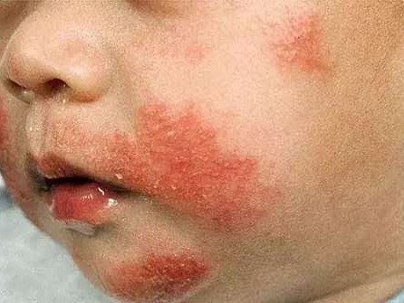 四,湿疹(eczema)见下图