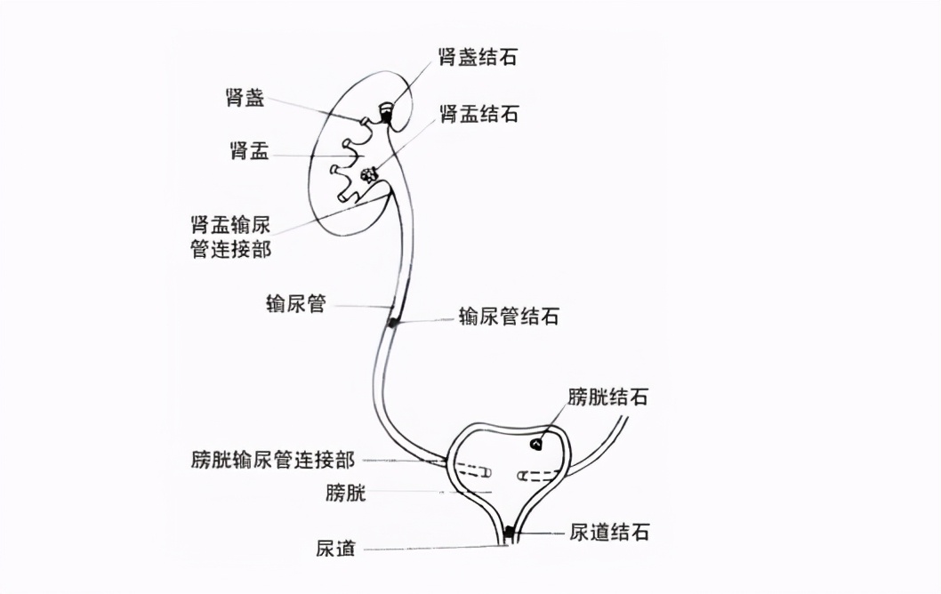 “肾积水怎么办？能不能出一期？”；医生说：关键是要清楚原因