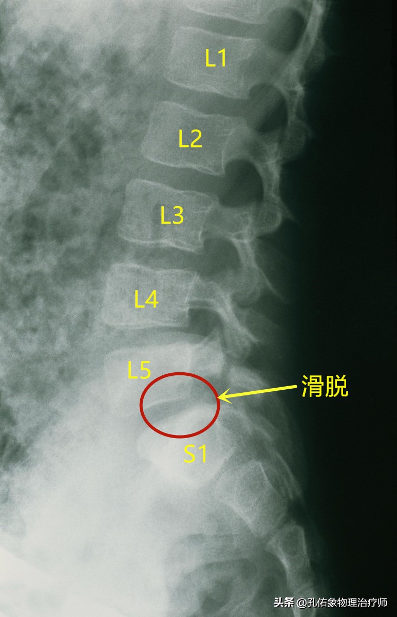 腰臀部疼或下肢麻木，是腰椎间盘突出吗？9种疾病需鉴别