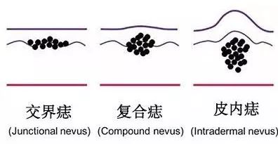 身上长痣，到底要不要治疗，是手术好还是激光治疗好？