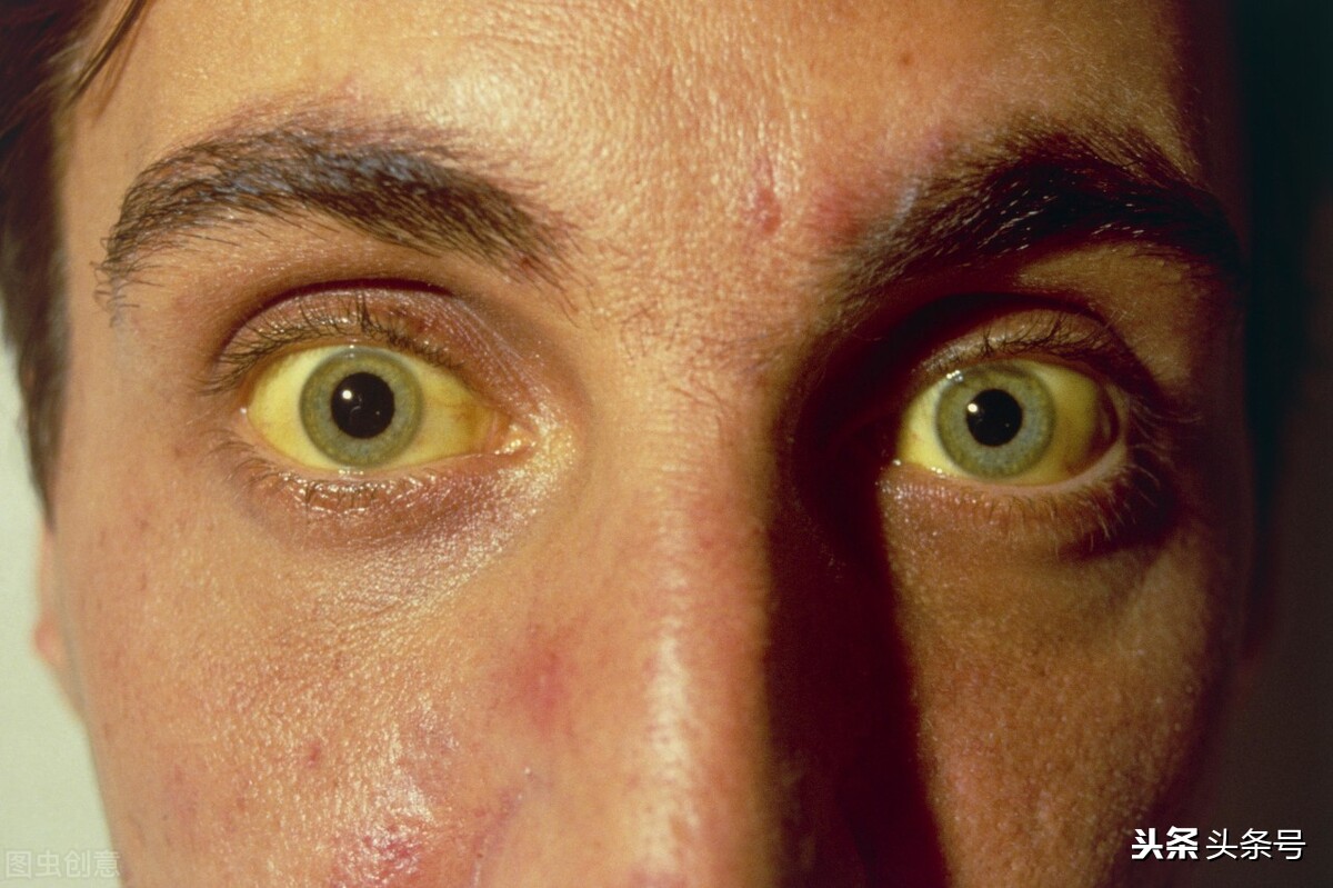 因為肝臟病變而引發的症狀－黃疸，病人的膚色會轉黃，眼白也會變成黃色。from: wikimedia - PanSci 泛科學