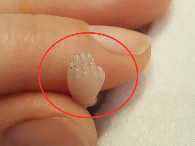 三个月怀孕成型图片(女子怀孕14周后流产) - 赤虎壹号