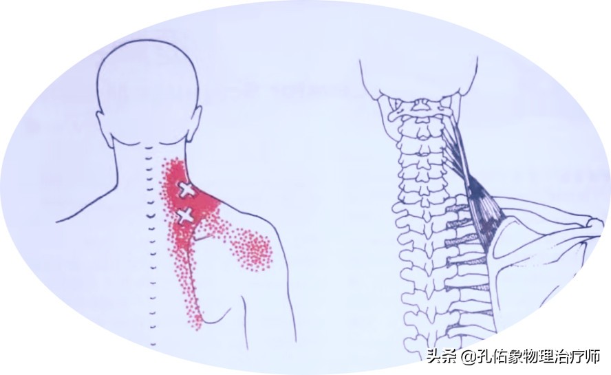 后背,肩胛骨区域疼痛是怎么回事?如何应对?告诉您