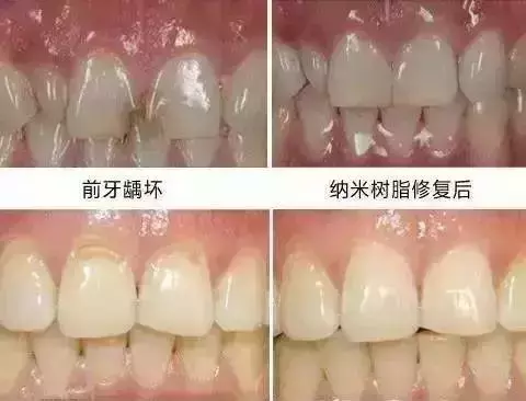 你补过牙吗?知道价格为什么差那么多吗?