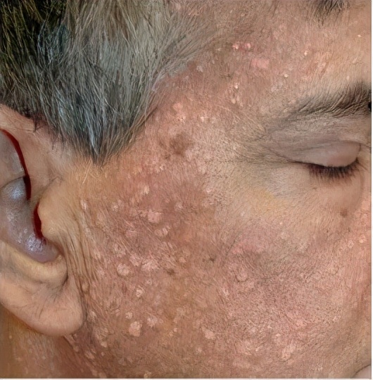 睑黄瘤图片(脸上长小颗粒是怎么回事)