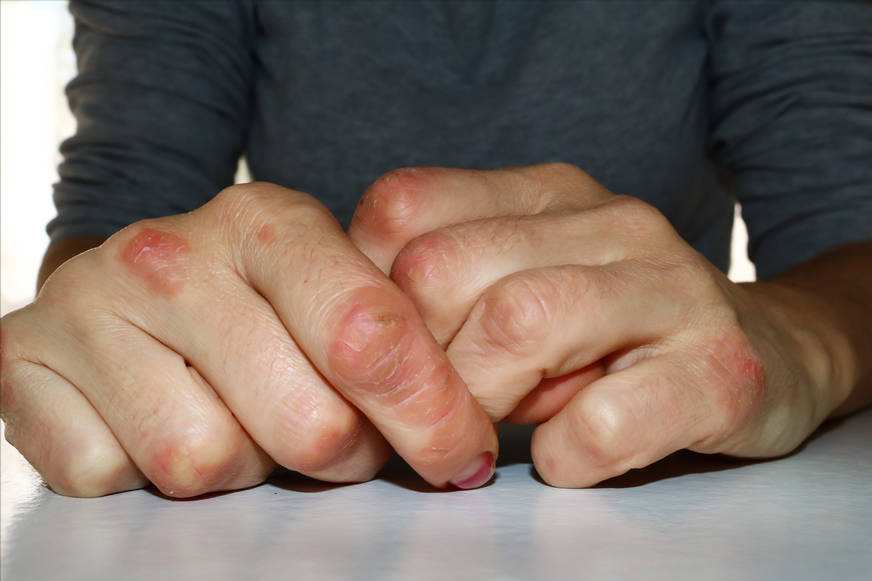 如果手部皮肤出现这两种异常,要小心是手癣