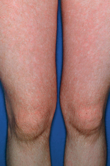 皮肌炎有什么样的皮肤改变?(1)