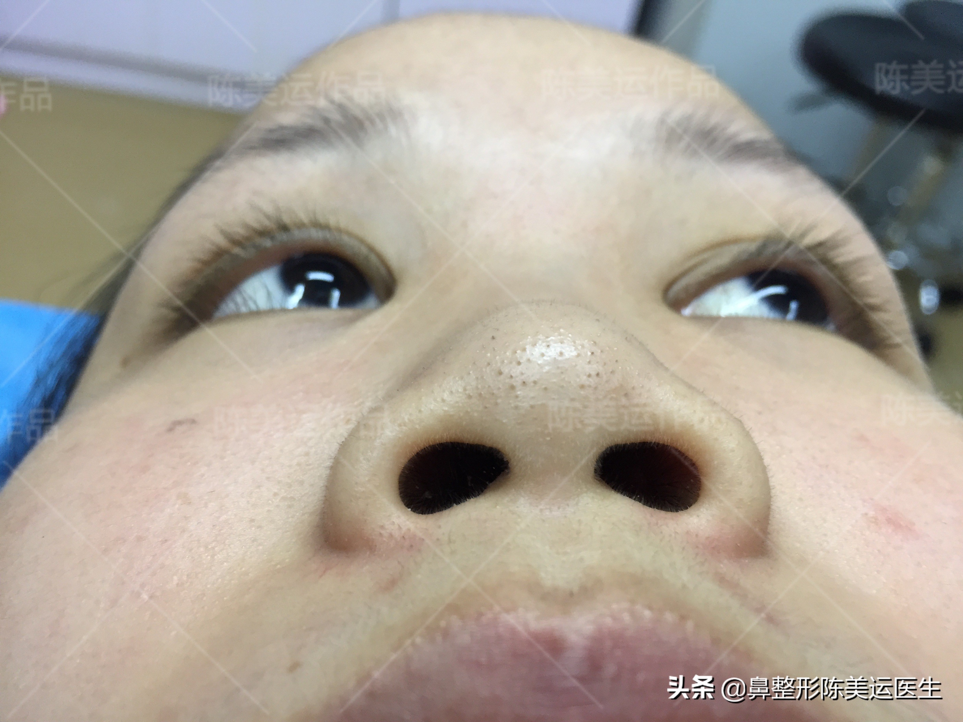 朝天鼻矫正难度大？难度有多大，效果就有多惊艳