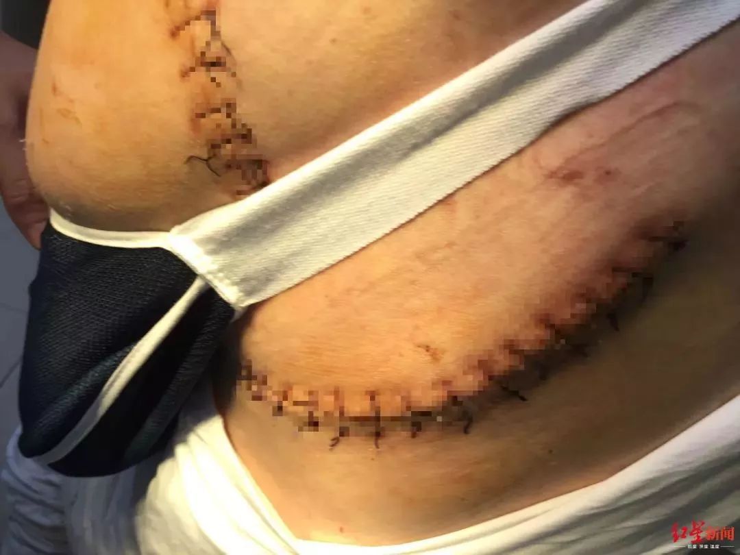 男子下班途中被狗撞倒，8根肋骨骨折！更头疼的是…