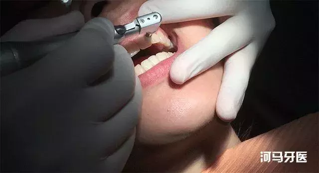 涂氟能预防蛀牙!孩子多大能涂?多长时间涂一次?需要注意啥?