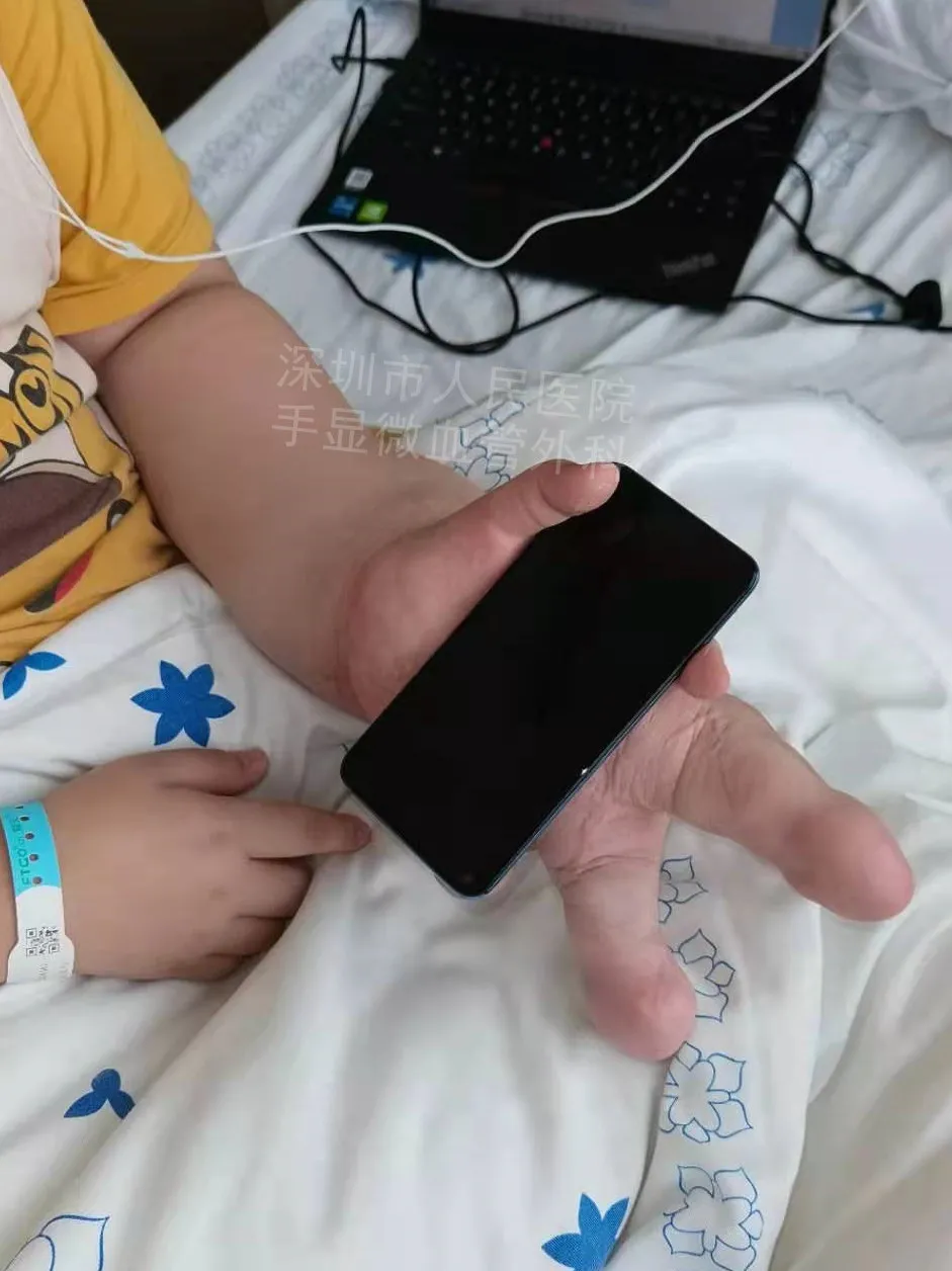 得了这病，12岁男孩手指比香蕉还粗！7种常见的手部畸形，家长们要注意