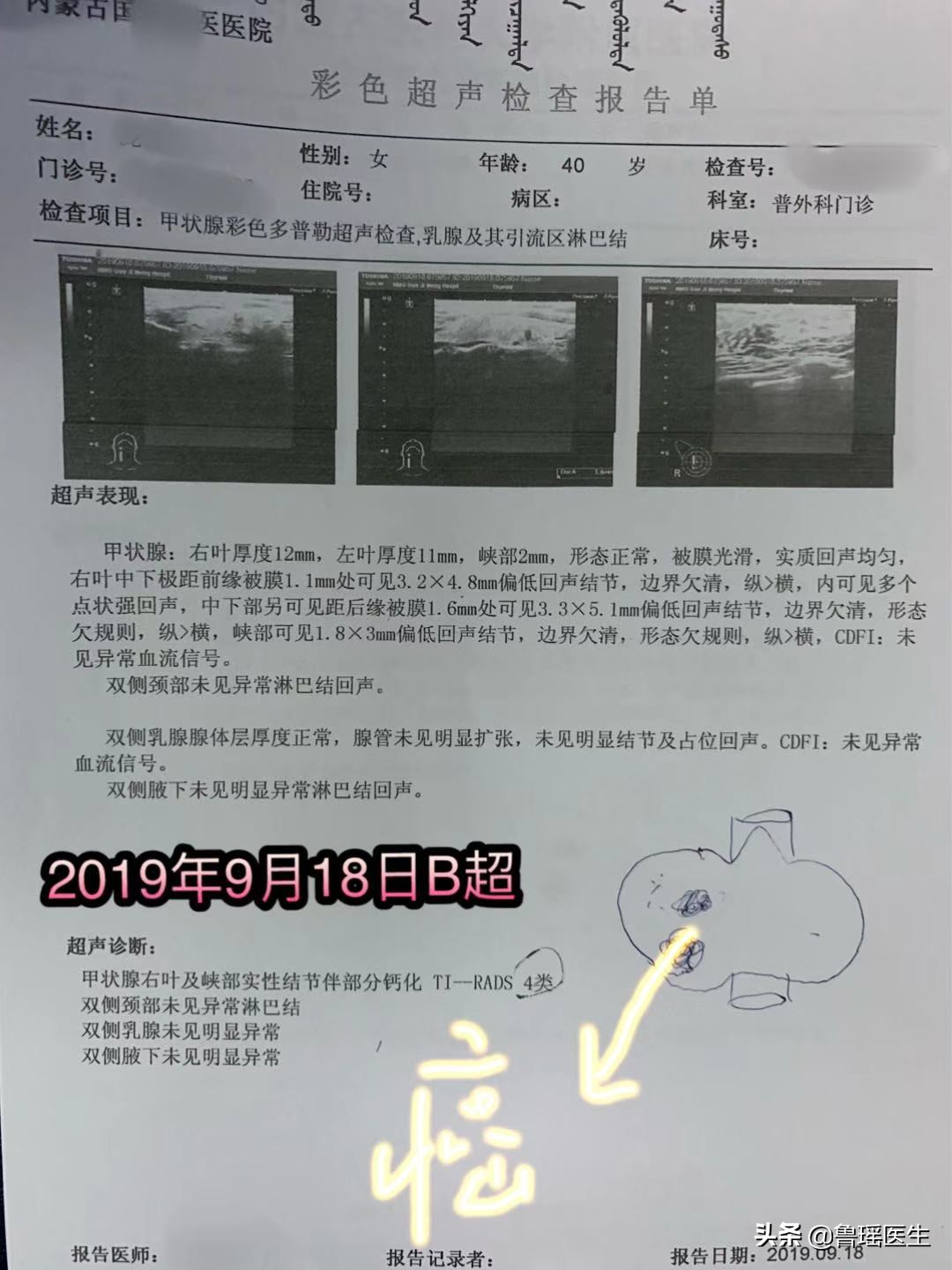 不同医院做的甲状腺B超结果会有差异吗？